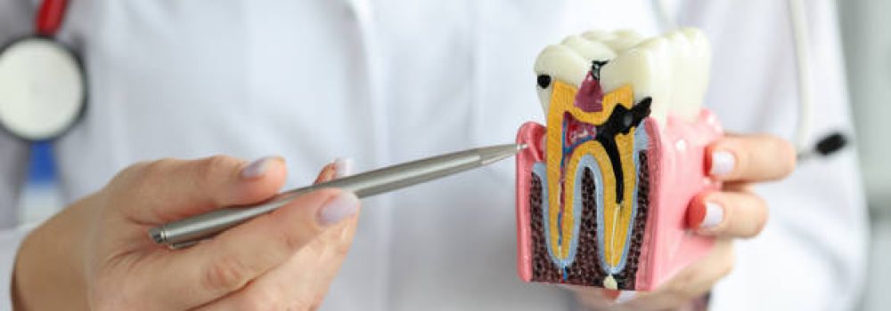 istockphoto-1355273989-612×612 Doctor showing carious cavity with ballpoint pen on plastic artificial tooth model closeup. Dental care concept
