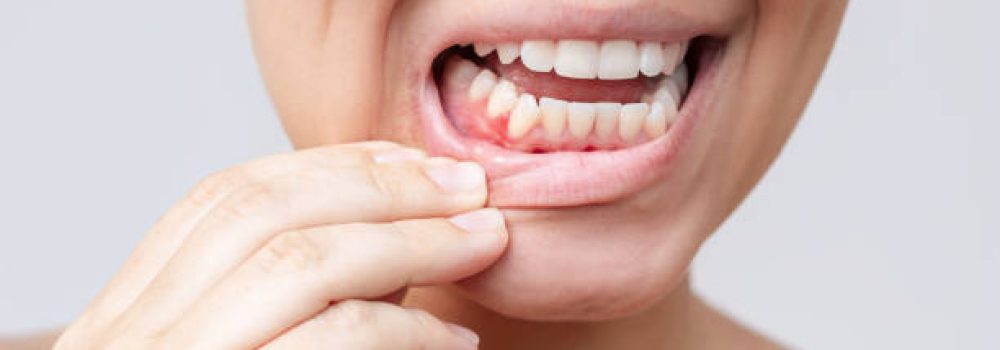 istockphoto-2168061104-612×612 A red lump on the gum near the tooth. Gingivitis, gum inflammation. Cropped shot of a young woman showing red inflamed gums isolated on a white background. Close up. Dentistry, dental care