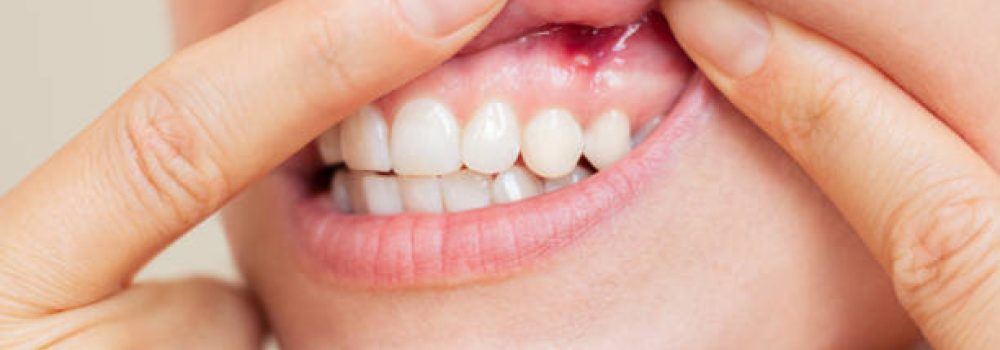 istockphoto-2192503459-612×612 A young woman suffering from stomatitis showing her gums with an inflamed ulcer on the mucous membrane in close-up