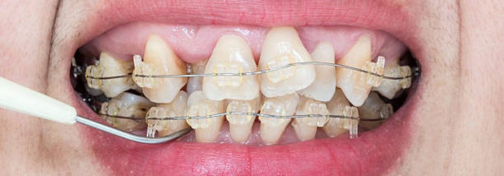 Close-up mouth of crooked teeth with braces and plaque remover Close-up mouth of crooked teeth with braces and plaque remover