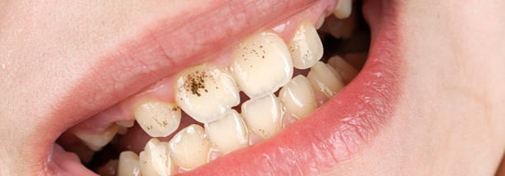 Staine teeth in human mouth, she is just 11 years. Staine teeth in human mouth, she is just 11 years.